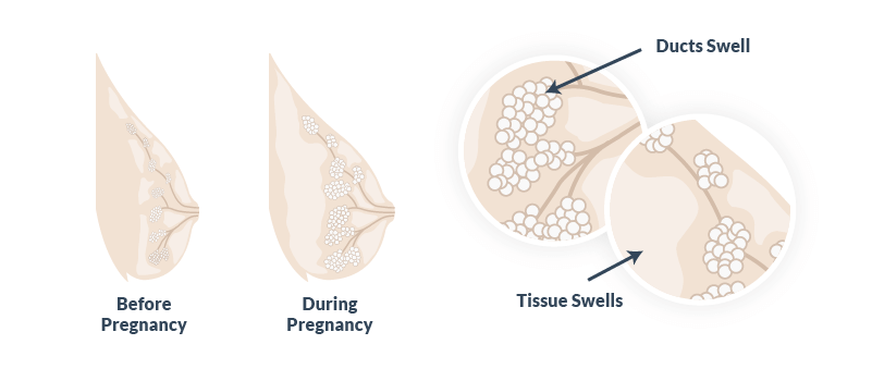 Sore Breasts In Pregnancy