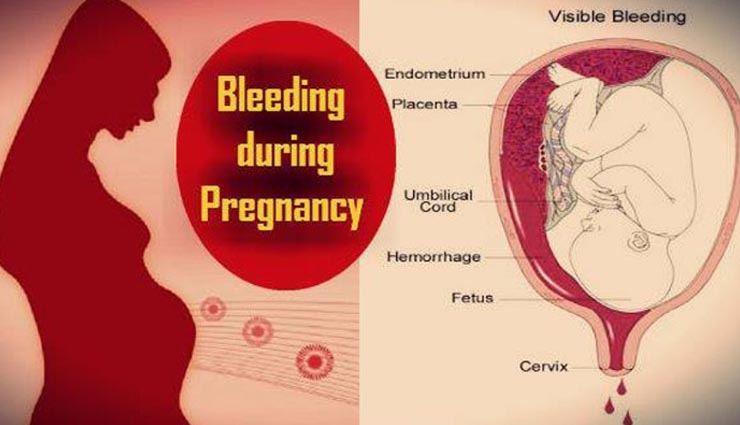 Bledding During pregnancy