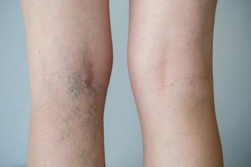 varicose vein in pregnancy treatment